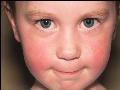 Những bệnh da liễu thường gặp ở trẻ